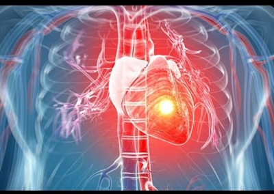 Coronary Angiography And Angioplasty