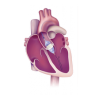 TAVI / TAVR Benefits